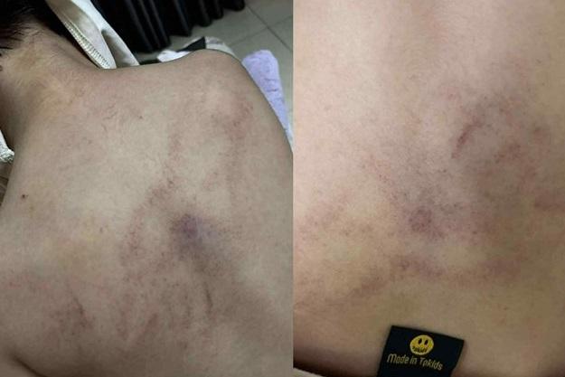 Cơ quan chức năng đang làm rõ những vết bầm tím trên người cháu bé học ở Trường Mầm non Gia Thụy, Hà Nội. baohanh