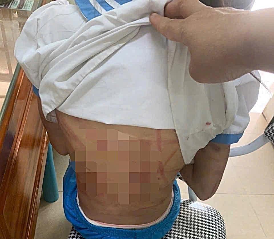 Bé gái bị cha dượng đánh đập tàn bạo bạo hành trẻ em