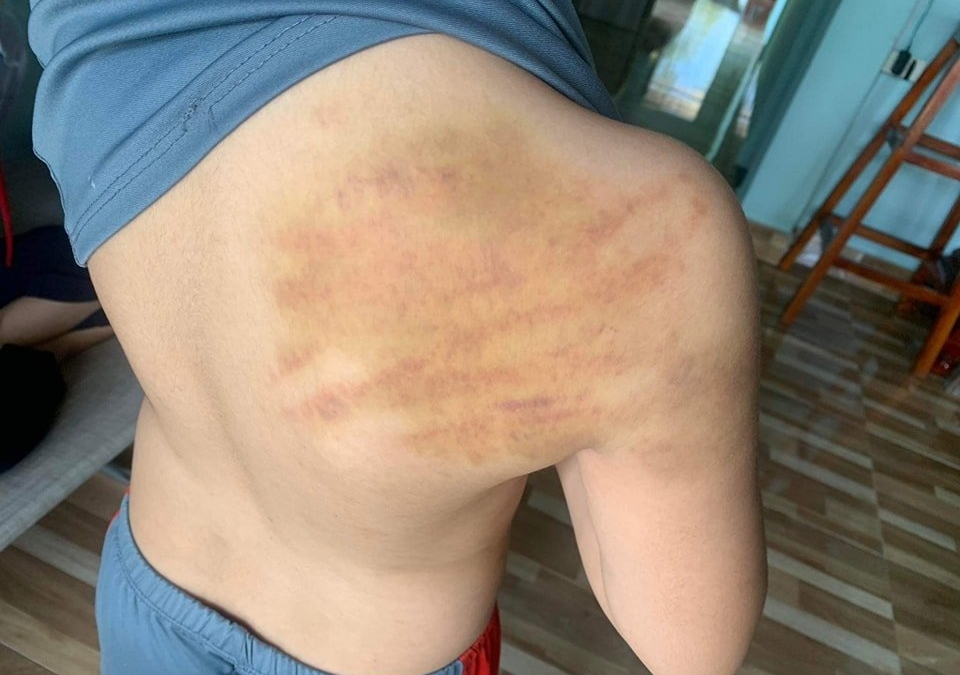 Vụ học sinh lớp 5 bị người dạy ‘chui’ đánh bầm tím lưng: Người bạo hành là bạn của mẹ bé