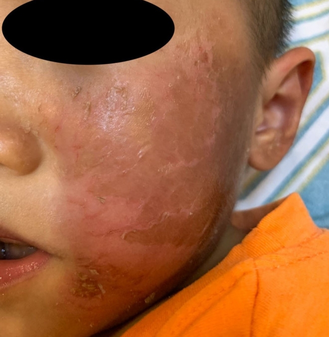 Cảnh báo nhiều trẻ bị bỏng rộp, đau rát da, nguy hiểm đến sức khoẻ vì đồ hóa trang Halloween