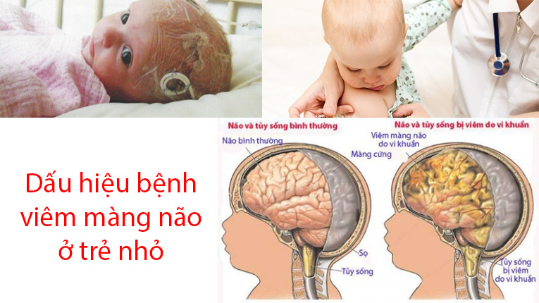 4. Các phương pháp điều trị bệnh viêm màng não ở trẻ em