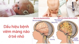 Dấu hiệu cảnh báo viêm màng não ở trẻ em mà cha mẹ cần biết