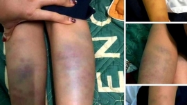 Sở GD&ĐT Đà Nẵng: Xử lý nghiêm vụ trẻ lớp 1 bị đánh bầm tím 2 chân