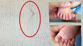 Bé gái 4 tháng tuổi suýt mất ngón chân vì sợi tóc