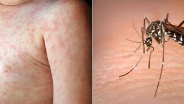 Chăm sóc tại nhà trẻ mắc bệnh sốt xuất huyết Dengue