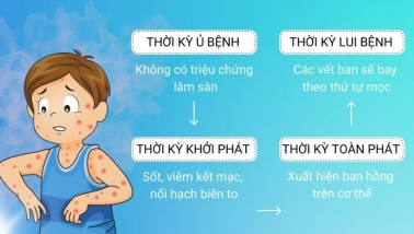 Bệnh sởi lây lan nhanh, trẻ nhỏ có thể tử vong vì biến chứng