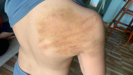Vụ học sinh lớp 5 bị người dạy ‘chui’ đánh bầm tím lưng: Người bạo hành là bạn của mẹ bé