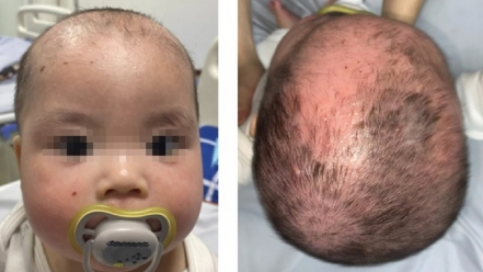 Tắm nhiều loại lá, bé trai 8 tháng tuổi bị bong tróc toàn bộ da mặt và đầu