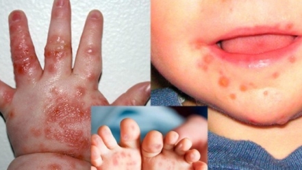 Vì sao bệnh tay chân miệng ở trẻ em lại nguy hiểm?