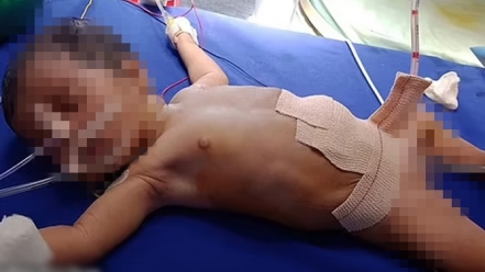 Bé gái sơ sinh ở Ấn Độ chứa 8 phôi thai trong cơ thể