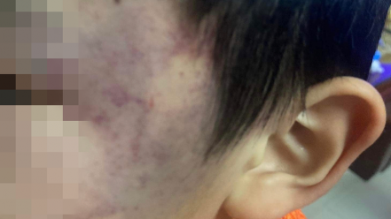 Hà Tĩnh: Bé trai 4 tuổi bị con cô giáo đánh tại trường