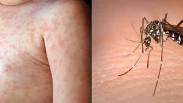 Chăm sóc tại nhà trẻ mắc bệnh sốt xuất huyết Dengue