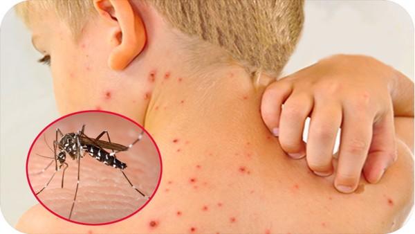 Bệnh tay chân miệng xuất hiện nhiều ở các trường học tại Hà Nội