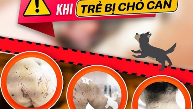 Bé gái 11 tuổi tử vong sau 2 tháng bị chó cắn