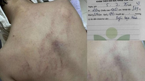Hội BVQTE Việt Nam đề nghị khẩn trương làm rõ việc phụ huynh tố giáo viên bạo hành trẻ mầm non 4 tuổi