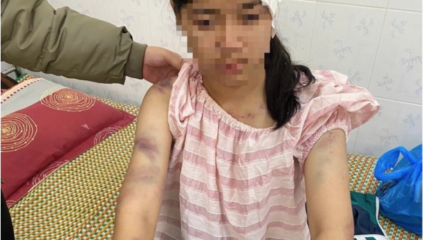 Hội Bảo vệ Quyền trẻ em yêu cầu xử lý nghiêm vụ bé gái 13 tuổi bị người thân tra tấn ở Thái Nguyên