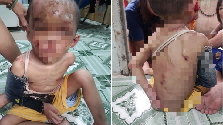 Vụ bé trai nghi bị cha mẹ ruột bạo hành ở Hóc Môn: Hội BVQTE TPHCM chính thức lên tiếng 